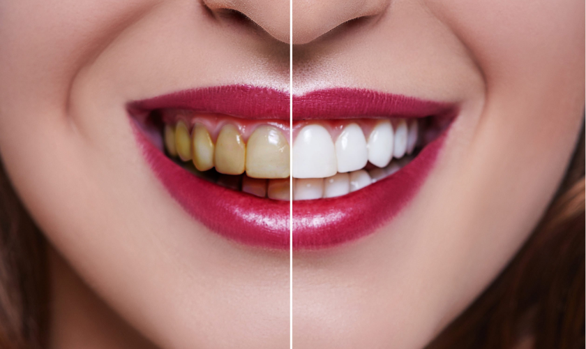 A Comprehensive Guide to Porcelain Veneers – Process, Benefits, and Care Tips