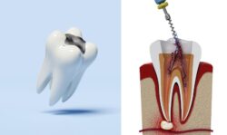 Filling or Root Canal